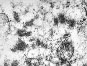 F,55y. | leiomyosarcoma - omentum F,55y. | leiomyosarcoma - omentum